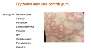 Cutaneous id reaction derma ppt dermatophytosis | PPTX