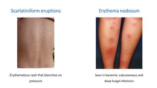 Cutaneous id reaction derma ppt dermatophytosis | PPTX