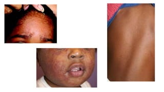 Cutaneous id reaction derma ppt dermatophytosis | PPTX