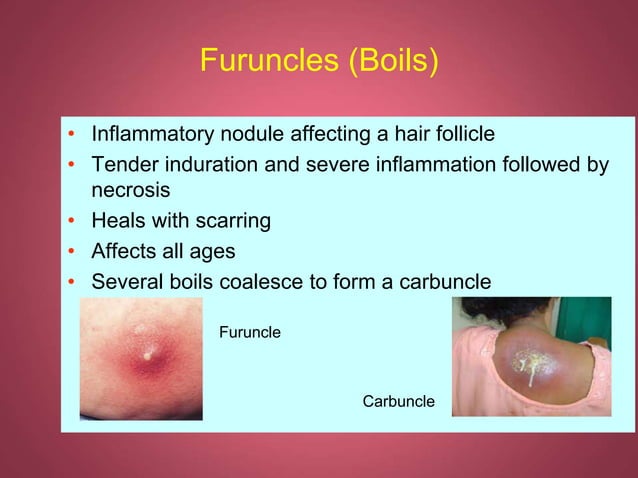 Cutaneous Infections of skin disease management | PPT