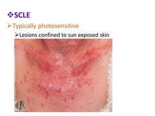 Scle Rash Skin Cutaneous lupus erythematosus | PPTX