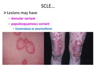 Scle Rash Skin Cutaneous lupus erythematosus | PPTX