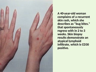 cutaneouslymphomas-120113180357-phpapp02.pptx