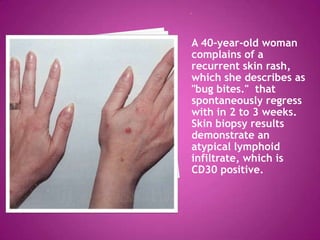 Lymphocitic Rash Cutaneous lymphomas | PPTX