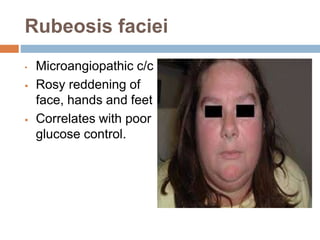 Subtle Rubeosis Cutaneous manifestations of endocrine disease | PPTX