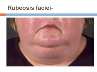 Subtle Rubeosis Cutaneous manifestations of endocrine disease | PPTX