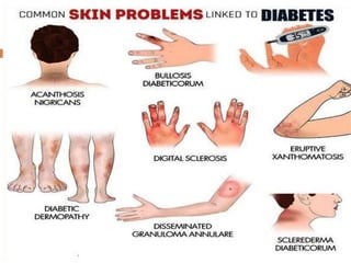 Endocrine Rashes Cutaneous manifestations of endocrine disease | PPTX