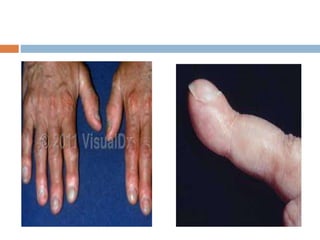 Endocrine Rashes Cutaneous manifestations of endocrine disease | PPTX