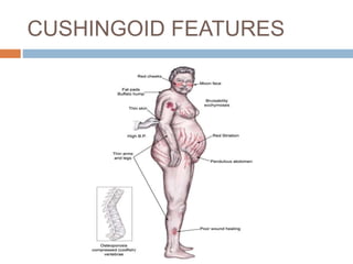 Cushingoid Rash Cutaneous manifestations of endocrine disease | PPTX