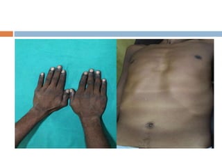 Endocrine Rashes Cutaneous manifestations of endocrine disease | PPTX
