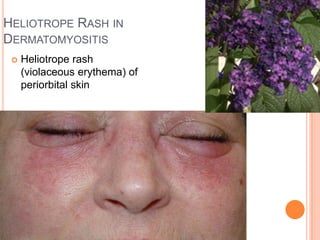 Haliotrop Rash Cutaneous manifestations of internal diseases | PPTX