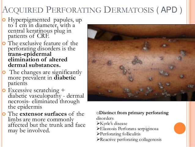 Treatment of acquired perforating dermatosis with ...