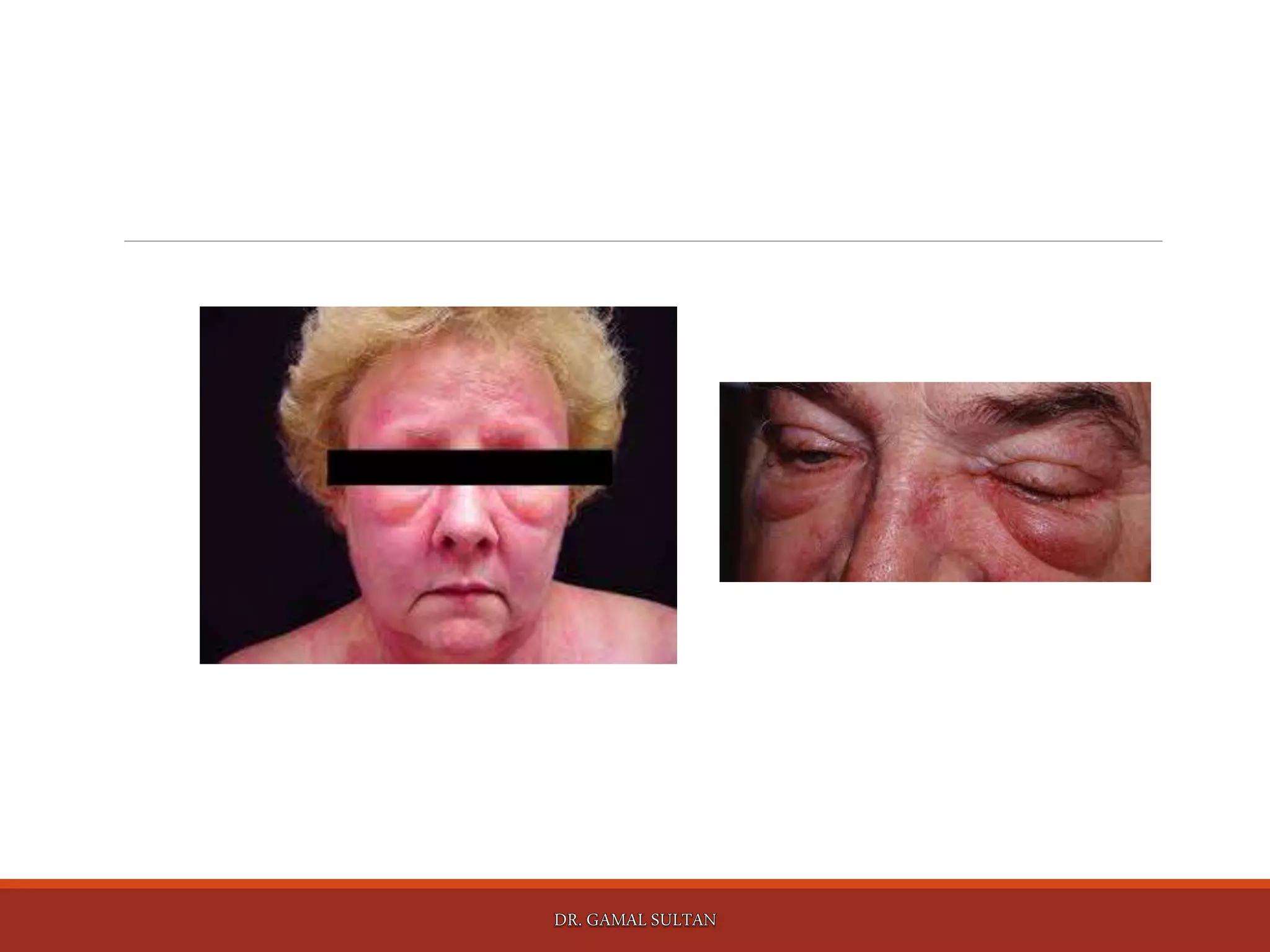 Paraneoplastic Leg Rash Cutaneous manifestations of internal malignancy and paraneoplastic ...