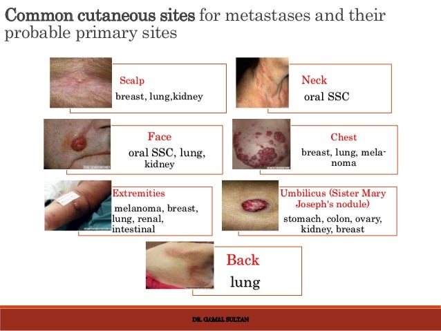 Cutaneous manifestations of internal malignancy and paraneoplastic sy…