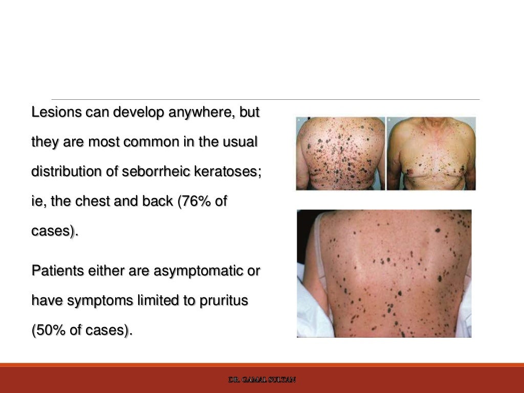 Cutaneous manifestations of internal malignancy and paraneoplastic sy…