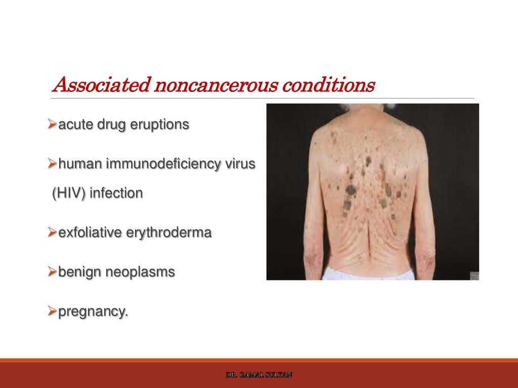Cutaneous manifestations of internal malignancy and paraneoplastic sy…