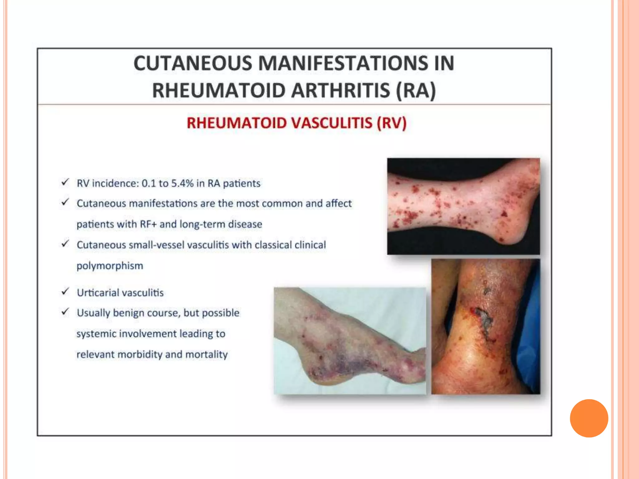 Cutaneous manifestations of rheumatoid arthritis | PPTX
