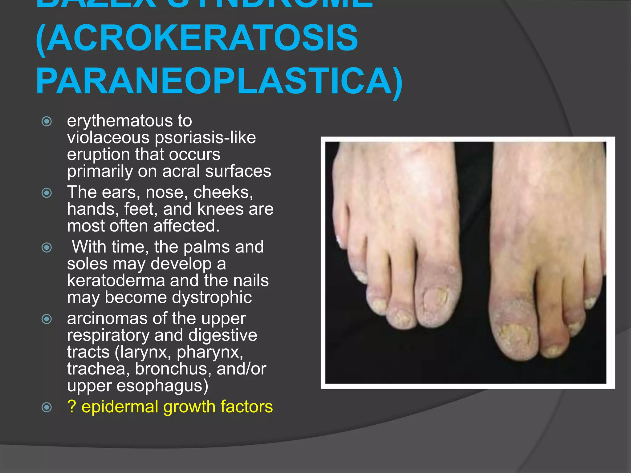 BAZEX SYNDROME
(ACROKERATOSIS
PARANEOPLASTICA)










erythematous to
violaceous psoriasis-like
eruption that occurs
primarily on acral surfaces
The ears, nose, cheeks,
hands, feet, and knees are
most often affected.
With time, the palms and
soles may develop a
keratoderma and the nails
may become dystrophic
arcinomas of the upper
respiratory and digestive
tracts (larynx, pharynx,
trachea, bronchus, and/or
upper esophagus)
? epidermal growth factors

 