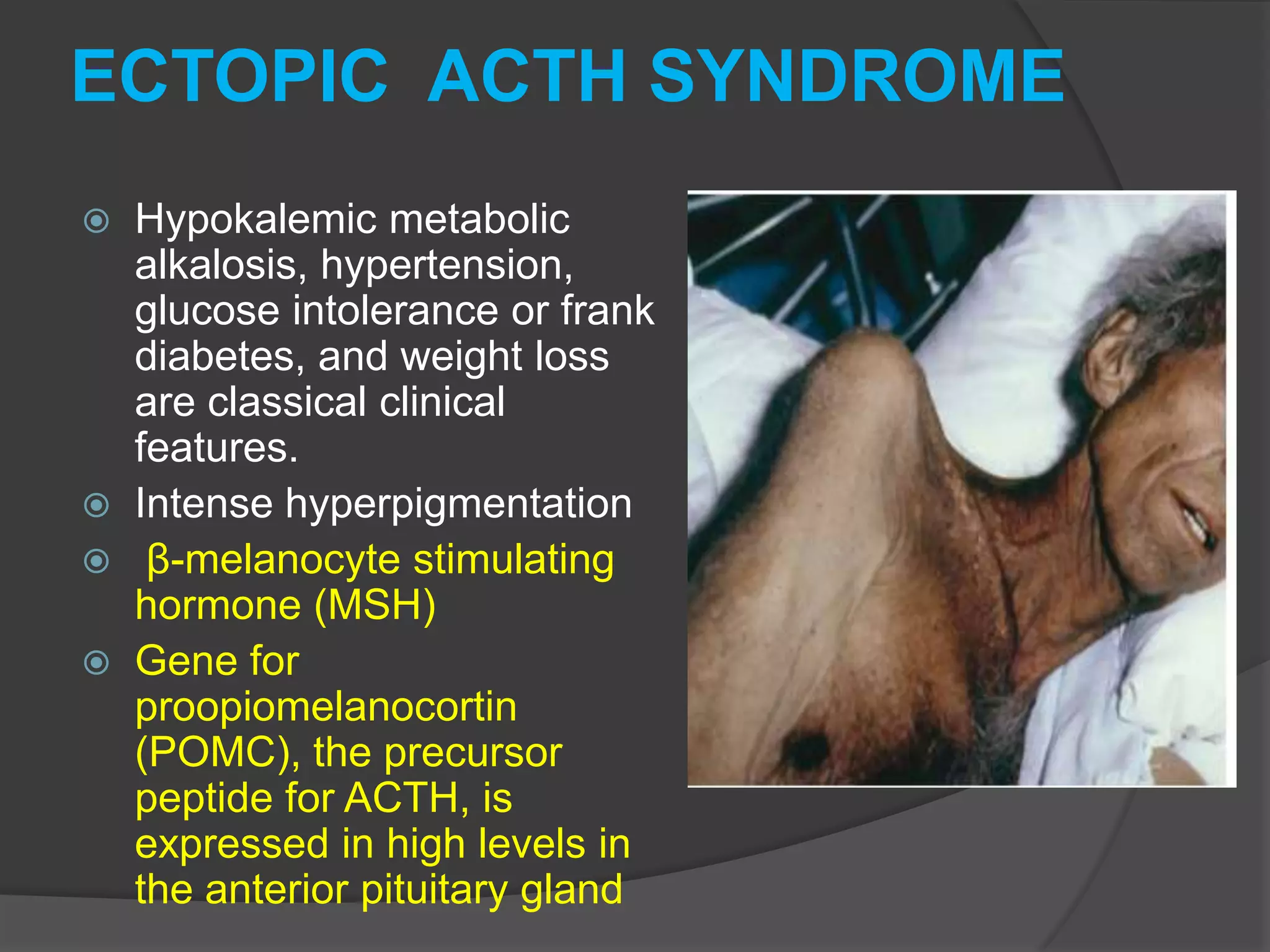 ECTOPIC ACTH SYNDROME
Hypokalemic metabolic
alkalosis, hypertension,
glucose intolerance or frank
diabetes, and weight loss
are classical clinical
features.
 Intense hyperpigmentation
 β-melanocyte stimulating
hormone (MSH)
 Gene for
proopiomelanocortin
(POMC), the precursor
peptide for ACTH, is
expressed in high levels in
the anterior pituitary gland


 