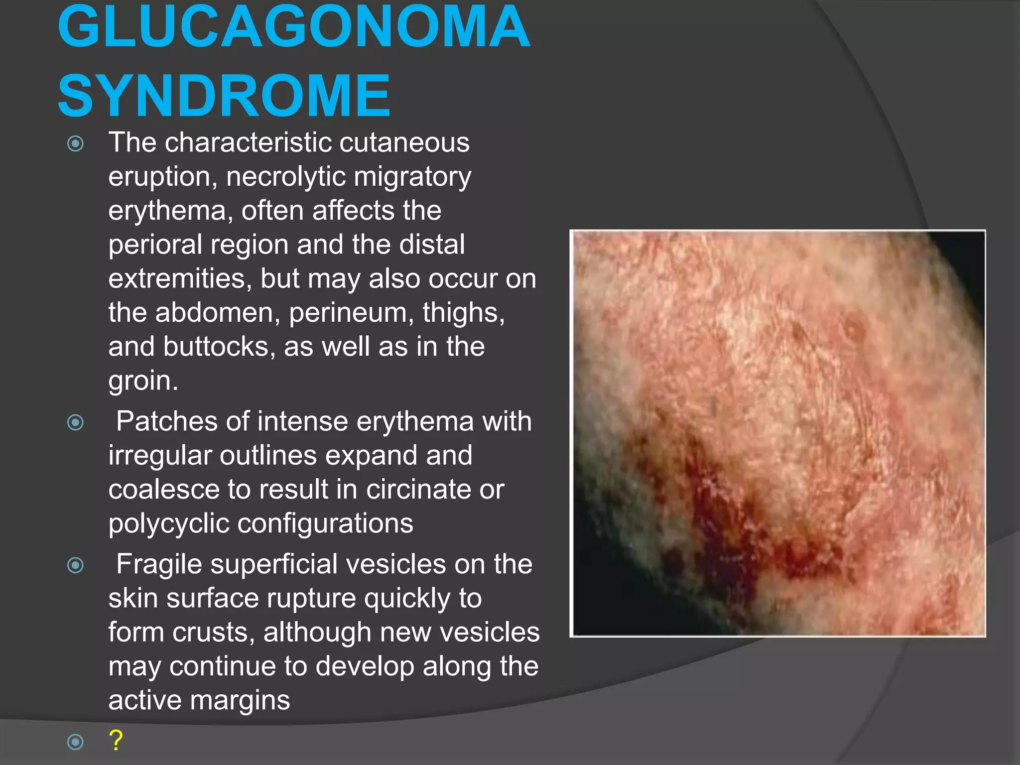 GLUCAGONOMA
SYNDROME








The characteristic cutaneous
eruption, necrolytic migratory
erythema, often affects the
perioral region and the distal
extremities, but may also occur on
the abdomen, perineum, thighs,
and buttocks, as well as in the
groin.
Patches of intense erythema with
irregular outlines expand and
coalesce to result in circinate or
polycyclic configurations
Fragile superficial vesicles on the
skin surface rupture quickly to
form crusts, although new vesicles
may continue to develop along the
active margins
?

 