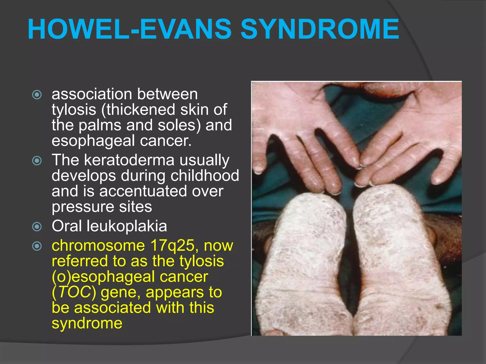 HOWEL-EVANS SYNDROME







association between
tylosis (thickened skin of
the palms and soles) and
esophageal cancer.
The keratoderma usually
develops during childhood
and is accentuated over
pressure sites
Oral leukoplakia
chromosome 17q25, now
referred to as the tylosis
(o)esophageal cancer
(TOC) gene, appears to
be associated with this
syndrome

 