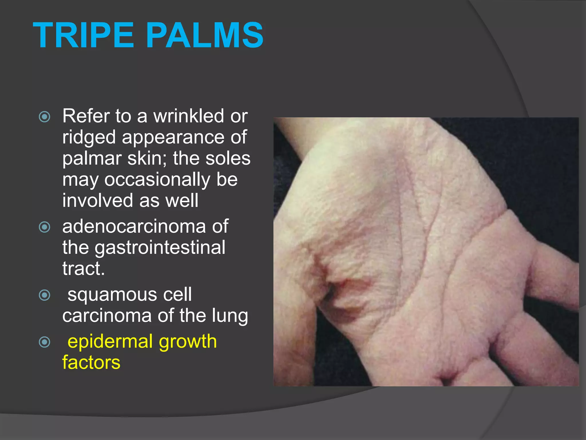 TRIPE PALMS







Refer to a wrinkled or
ridged appearance of
palmar skin; the soles
may occasionally be
involved as well
adenocarcinoma of
the gastrointestinal
tract.
squamous cell
carcinoma of the lung
epidermal growth
factors

 