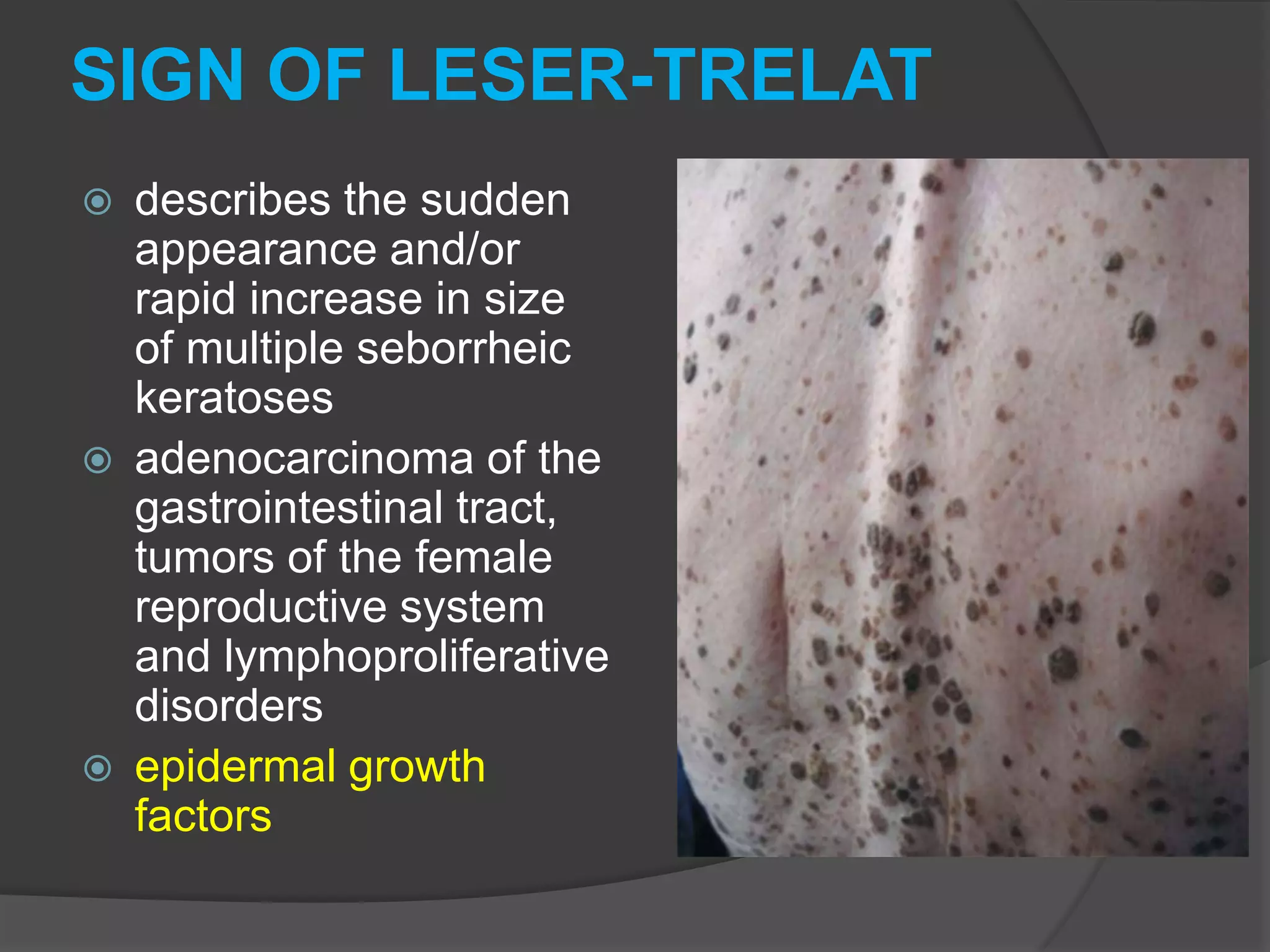 SIGN OF LESER-TRELAT






describes the sudden
appearance and/or
rapid increase in size
of multiple seborrheic
keratoses
adenocarcinoma of the
gastrointestinal tract,
tumors of the female
reproductive system
and lymphoproliferative
disorders
epidermal growth
factors

 