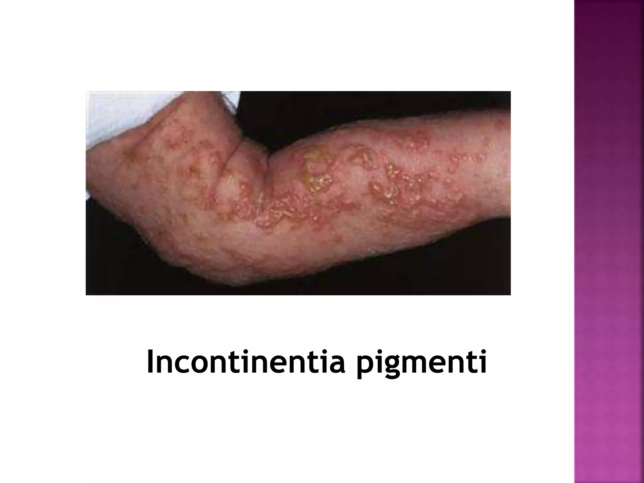 Cutaneous Mosaicisms Concepts Patterns And Classifications Dr 