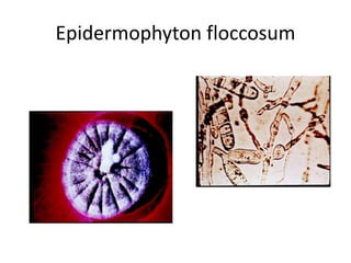 Epidermophyton floccosum
Bifurcated hyphae with multiple,
smooth, club shaped macroconidia (2-
4 cells)
 
