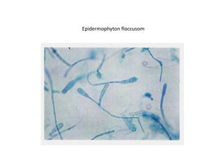 Epidermophyton floccusom
 