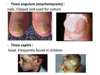- Tinea unguium (onychomycosis) :
nails. Clipped and used for culture
- Tinea capitis :
head. Frequently found in children
 