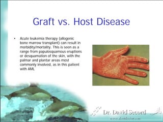 Cutaneous Presentations Of Systemic Diseases