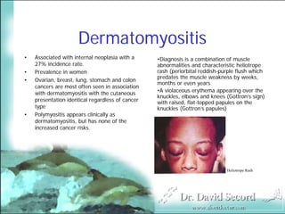 Cutaneous Presentations Of Systemic Diseases