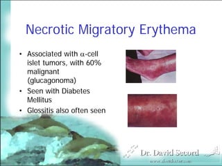 Cutaneous Presentations Of Systemic Diseases