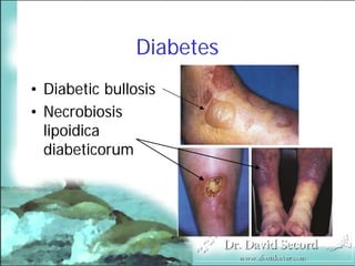 Cutaneous Presentations Of Systemic Diseases