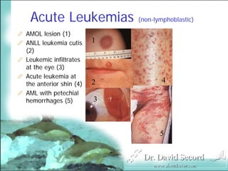 Cutaneous Presentations Of Systemic Diseases