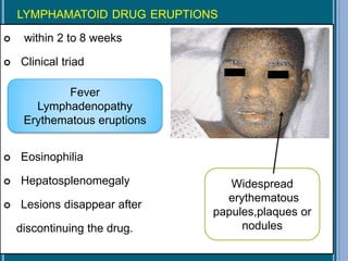 LYMPHAMATOID DRUG ERUPTIONS
 within 2 to 8 weeks
 Clinical triad
 Eosinophilia
 Hepatosplenomegaly
 Lesions disappear after
discontinuing the drug.
Fever
Lymphadenopathy
Erythematous eruptions
Widespread
erythematous
papules,plaques or
nodules
 