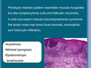  Prototypic reaction pattern resembles mycosis fungoides
but also lymphocytoma cutis and follicular mucinosis.
 In anti-convulsant induced pseudolymphoma syndrome,
the lymph node may show focal necrosis, eosinophilic
and histiocyte infiltration.
•Acanthosis
•Minimal spongiosis
•Epidermotropic
lymphocytes
 