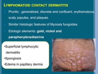 LYMPHOMATOID CONTACT DERMATITIS
 Pruritic , generalized, discrete and confluent, erythematous,
scaly papules, and plaques.
 Similar histologic features of Mycosis fungoides.
 Etiologic elements: gold, nickel and
paraphenylenediamine
•Superficial lymphocytic
dermatitis
•Spongiosis
•Edema in papillary dermis
 