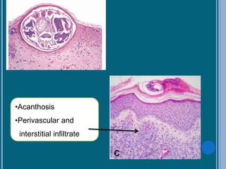 •Acanthosis
•Perivascular and
interstitial infiltrate
 