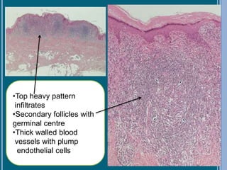 •Top heavy pattern
infiltrates
•Secondary follicles with
germinal centre
•Thick walled blood
vessels with plump
endothelial cells
 