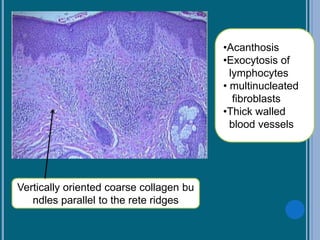 •Acanthosis
•Exocytosis of
lymphocytes
• multinucleated
fibroblasts
•Thick walled
blood vessels
Vertically oriented coarse collagen bu
ndles parallel to the rete ridges
 