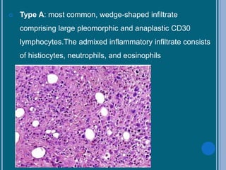  Type A: most common, wedge-shaped infiltrate
comprising large pleomorphic and anaplastic CD30
lymphocytes.The admixed inflammatory infiltrate consists
of histiocytes, neutrophils, and eosinophils
 