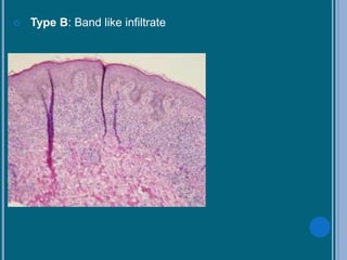  Type B: Band like infiltrate
 