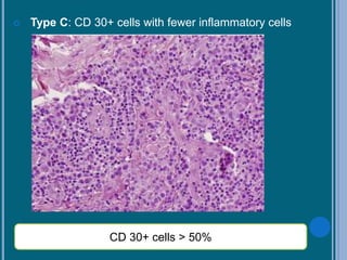  Type C: CD 30+ cells with fewer inflammatory cells
CD 30+ cells > 50%
 