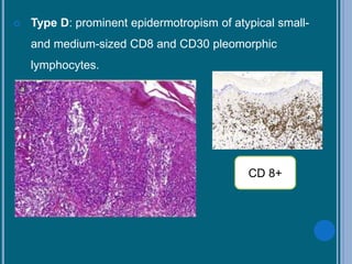  Type D: prominent epidermotropism of atypical small-
and medium-sized CD8 and CD30 pleomorphic
lymphocytes.
CD 8+
 
