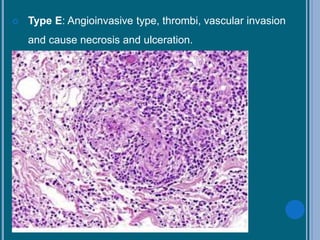  Type E: Angioinvasive type, thrombi, vascular invasion
and cause necrosis and ulceration.
 