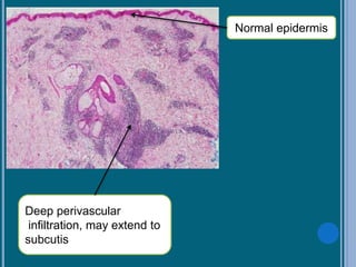 Deep perivascular
infiltration, may extend to
subcutis
Normal epidermis
 