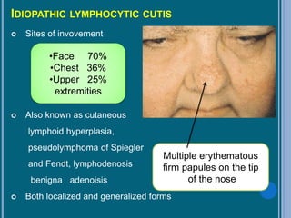 IDIOPATHIC LYMPHOCYTIC CUTIS
 Sites of invovement
 Also known as cutaneous
lymphoid hyperplasia,
pseudolymphoma of Spiegler
and Fendt, lymphodenosis
benigna adenoisis
 Both localized and generalized forms
•Face 70%
•Chest 36%
•Upper 25%
extremities
Multiple erythematous
firm papules on the tip
of the nose
 