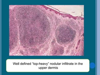 Well defined “top-heavy” nodular infiltrate in the
upper dermis
 
